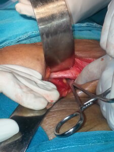 Defect in the femoral ring