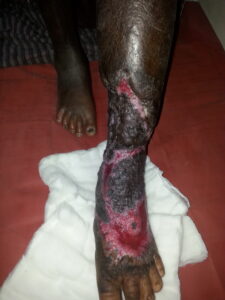 Healed wound after Skin grafting