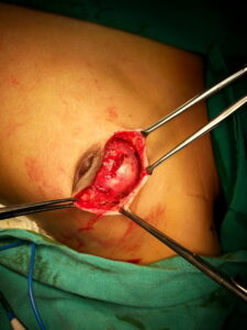 Benign tumour in the breast