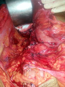 Tumour bed after removing the tumour