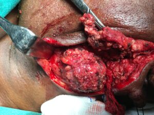 Tumour in the parotid Gland