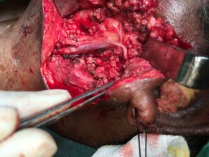 Preserving the facial Nerve during surgery