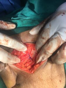 Repair of the Femoral hernia defect
