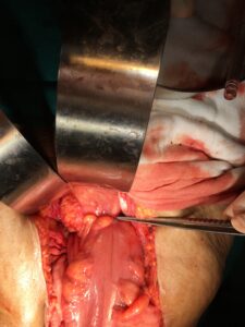Tumour in the rectum causing narrowing of the intestine