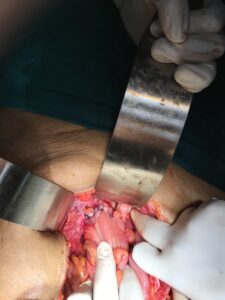 Rejoining of the cut ends of intestines