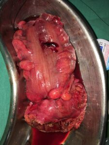 Removed specimen of the tumour along with intestine