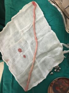 Defective veins being removed