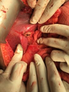 Patient underwent Cholecystectomy else where and diagnosed to have Cancer on biopsy