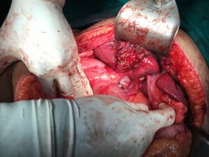 Wedge resection of the Liver
