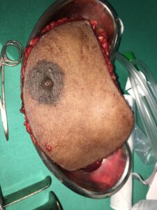 specimen of the breast removed with tumour