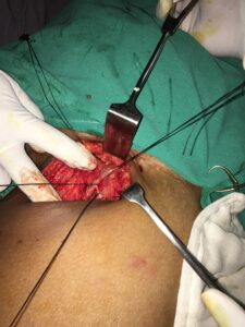 Defective veins identifies during surgery