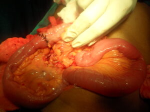 Joining the Intestines again after removing the tumour
